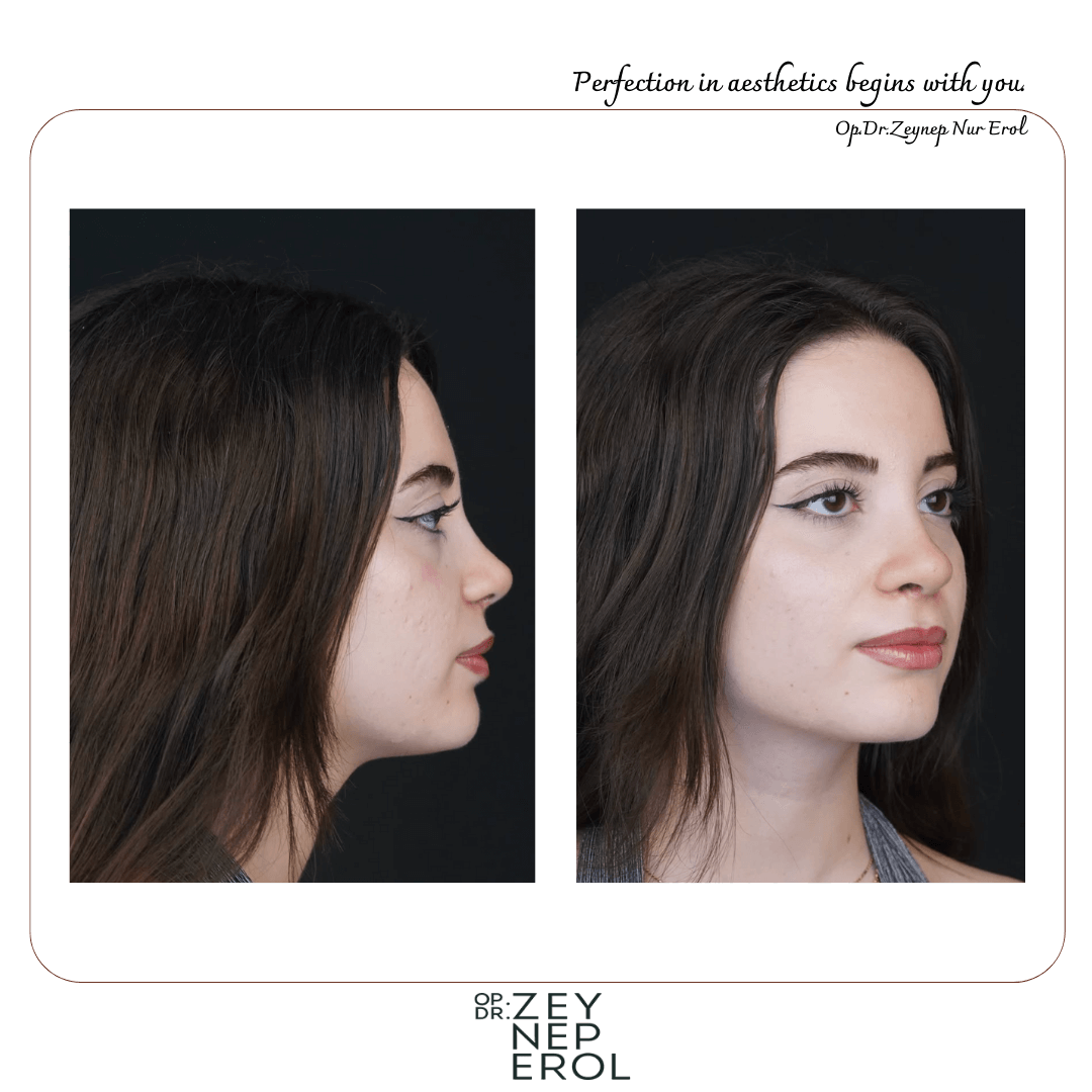Burun Estetiği - Rinoplasti
