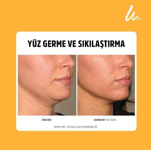 Ultherapy - Ameliyatsız Cilt Germe